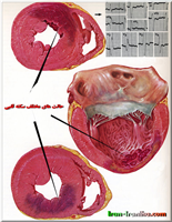  سکته  ی  قلبی،(Myocardial  Infarction)  یعنی  انهدام  و  مرگ  دائم  و  غیرقابل  برگشت  سلولی  در  بخشی  از  عضلات  قلب.  در  این  تصویر  از  بین  رفتن  عضله  ی  قلبی  را  در  نواحی  مختلف  آن  می  توانید  ملاحظه  کنید. 