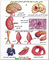  پلاک  های  انسدادی  در  تمام  شریان  ها  می  توانند  باعث  تنگی  شریان  و  ایسکمی  عضو  هدف  شوند.  ما  معمولاً  درباره  ی  سکته  ی  قلبی  و  سکته  ی  مغزی  می  شنویم  اما  سایر  ارگان  های  بدن  نیز  می  توانند  دچار  ایسکمی  و  مرگ  سلولی  ناشی  از  وجود  پلاک  های  انسدادی  شوند. 