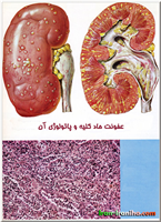  عفونت  کلیه  را  پیلونفریت  (Pyelonephritis)  می  گویند.  عفونت  کلیه  می  تواند  به  صورت  حاد  یا  مزمن  باشد.  عفونت  کلیه  می  تواند  دلایل  متعدد  و  منشاء  مختلف  داشته  باشد.  عفونت  می  تواند  از  طریق  خون  منتقل  شده  باشد  یا  از  طریق  سیستم  مجاری  ادراری  و  مثانه  به  صورت  صعودی  انتقال  یافته  باشد.  پیلونفریت  حاد  معمولاً  با  تب  شدید،  درد  پهلو  و  تهوع  و  استفراغ  همراه  است. 