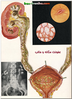  عفونت  مثانه  را  سیستیت  (Cystitis)  و  عفونت  مجرا  را  اورتریت  (Uretritis)  می  گویند.  علائم  ابتلا  به  عفونت  مثانه  و  مجرا  به  شدت  علائم  عفونت  کلیه  نیست.  به  همین  دلیل  بسیاری  از  بیماران  به  آن  بی  توجهی  می  کنند  و  همین  بی  توجهی  باعث  بروز  صدمات  بیشتری  می  شود. 
